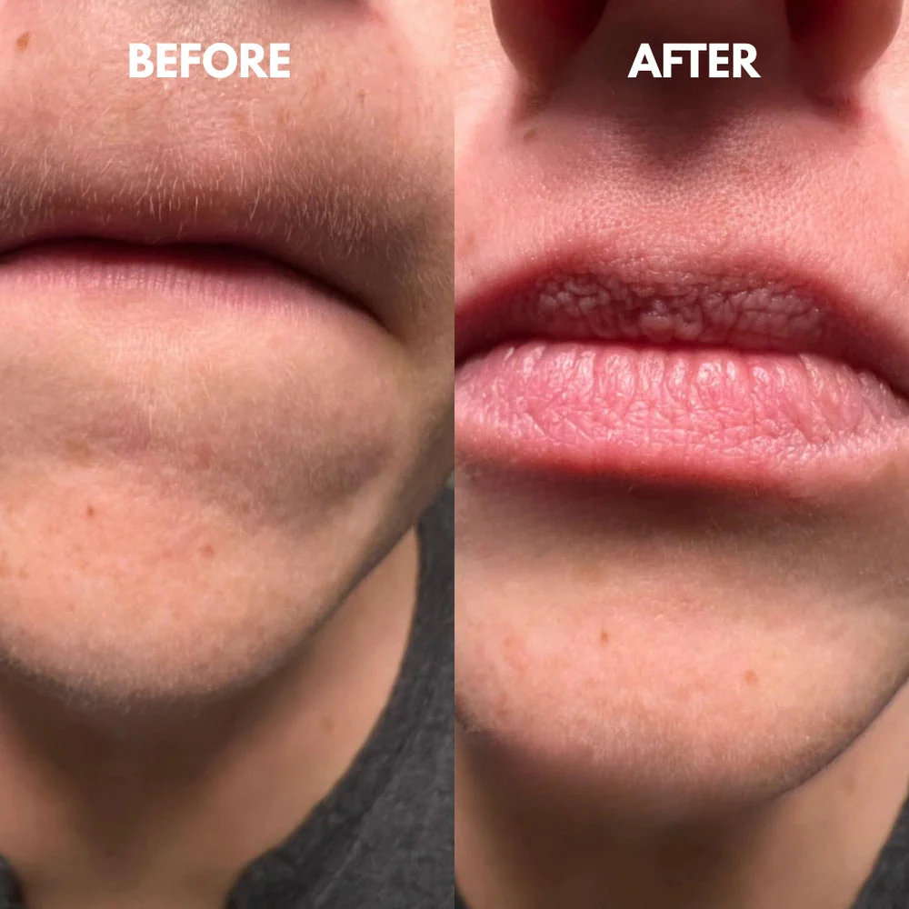 SilkRooter – Gentle, Irritation-Free Facial Hair Removal with Long-Lasting Results - Image 2